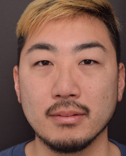 Before Image: Upper Blepharoplasty and Lower Blepharoplasty - front