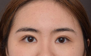 After Image: Upper Blepharoplasty and Epicanthoplasty