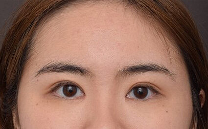 After Image: Upper Blepharoplasty and Epicanthoplasty - front