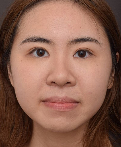 After Image: Upper Blepharoplasty and Epicanthoplasty - front