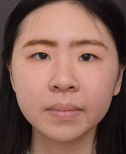 Before Image: Upper Blepharoplasty and Epicanthoplasty