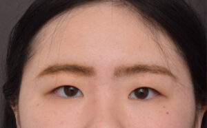 Before Image: Upper Blepharoplasty and Epicanthoplasty