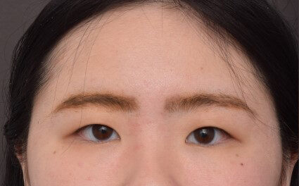 Before Image: Upper Blepharoplasty and Epicanthoplasty - front