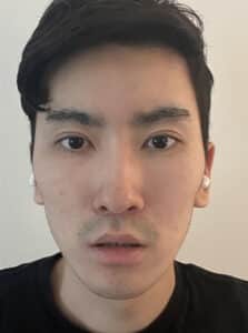 After Image: Upper Blepharoplasty