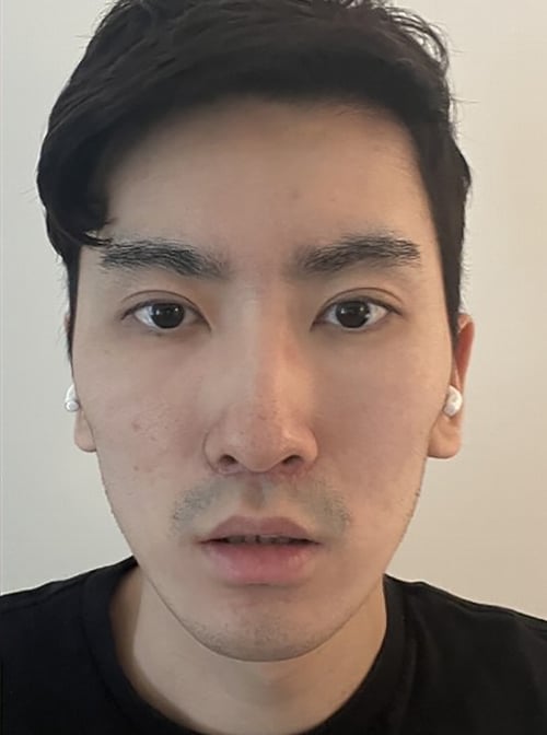 After Image: Upper Blepharoplasty - front