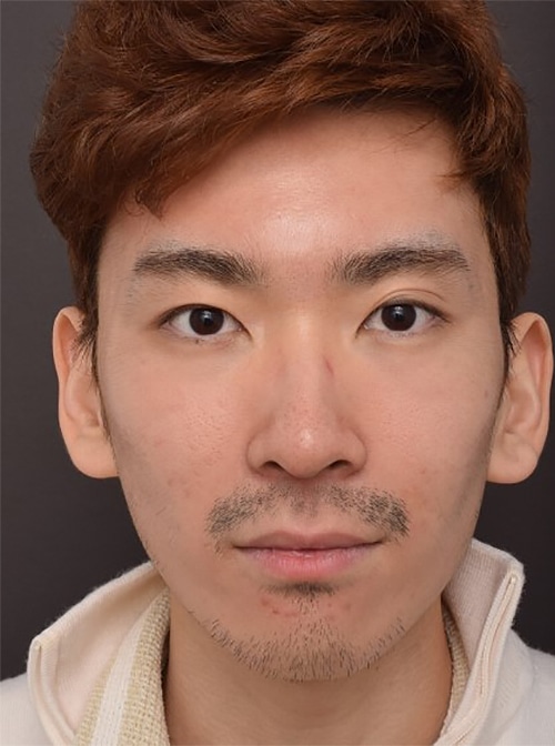 Before Image: Upper Blepharoplasty - front