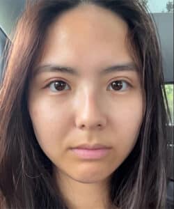 After Image: Upper Blepharoplasty