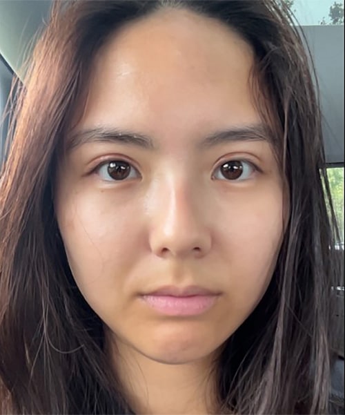 After Image: Upper Blepharoplasty - front