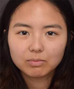 Before Image: Upper Blepharoplasty