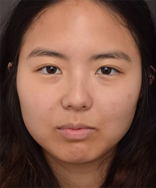 Before Image: Upper Blepharoplasty - front