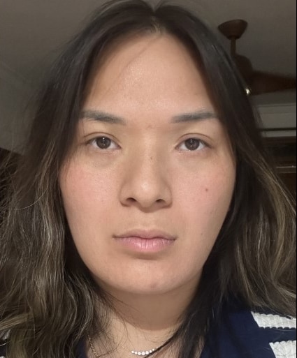 After Image: Upper Blepharoplasty, Epicanthoplasty and Ptosis Repair Surgery - front