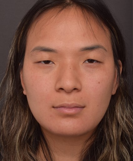 Before Image: Upper Blepharoplasty, Epicanthoplasty and Ptosis Repair Surgery - front